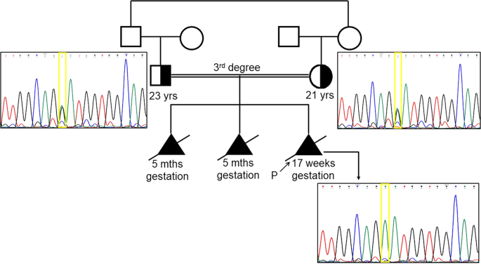 A Newly Recognized Multiple Malformation Syndrome With Caudal Regression Associated With A Biallelic C 402g A Variant In Tbx4 European Journal Of Human Genetics