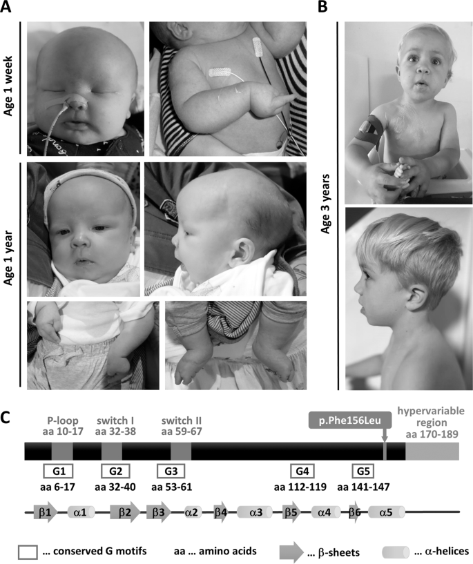 Fig. 1: Photographs of patients 1 and 2.
