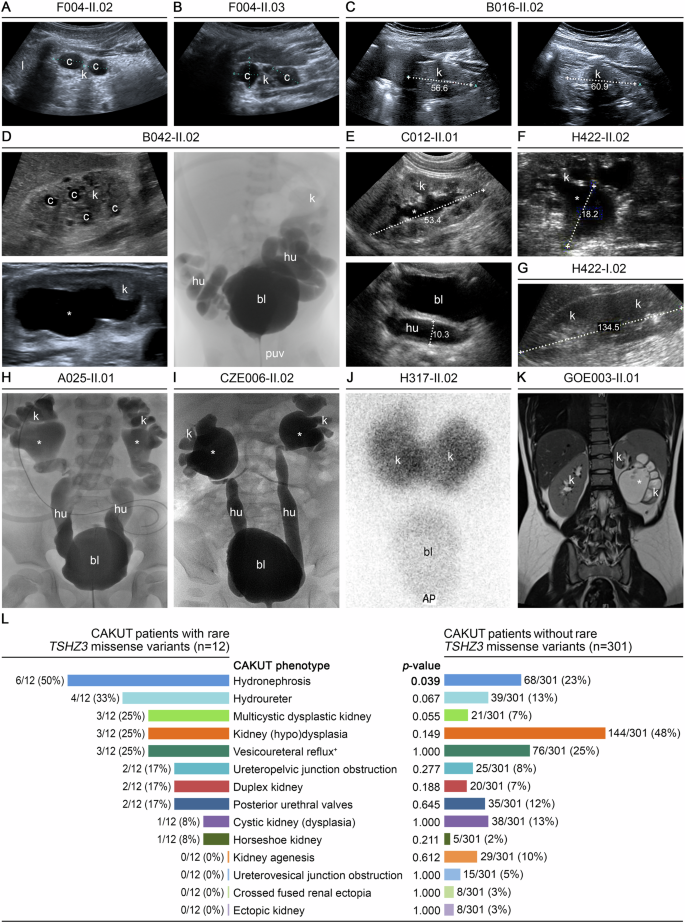 Fig. 2: CAKUT phenotypes of patients carrying TSHZ3 variants, and comparison of CAKUT phenotype frequency in patients with and without TSHZ3 variants.