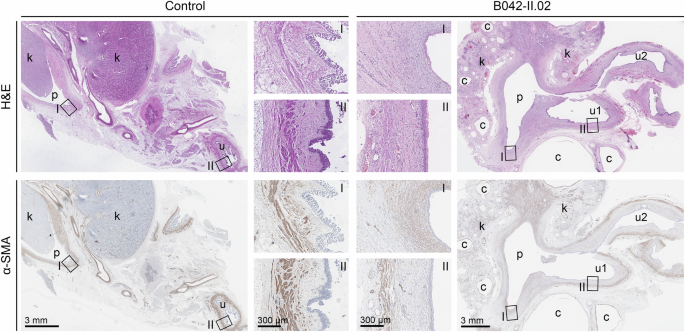 Fig. 3: Histological characterization of a nephrectomy specimen from two-months-old male patient B042-II.02 (right panels) carrying the TSHZ3:c.172A>G p.(Ser58Gly) variant identified in five families, and a control specimen removed at autopsy from a one-year-old male with normal kidneys (left panels).