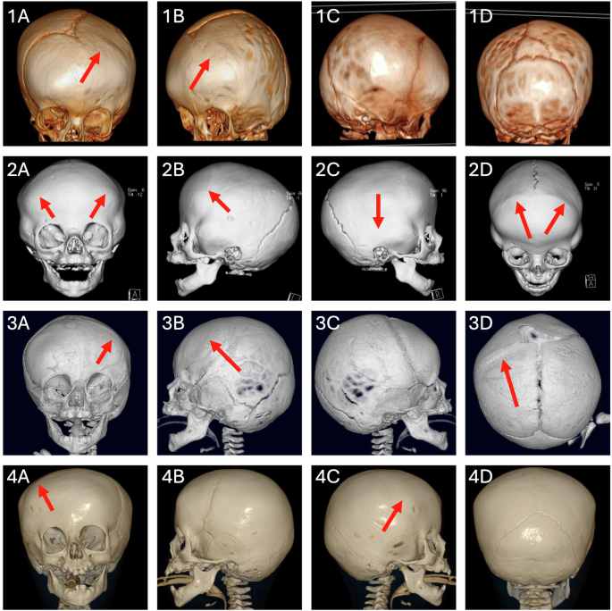 Fig. 1: Pre-operative images of 3D CT scans of Patients 1-4.