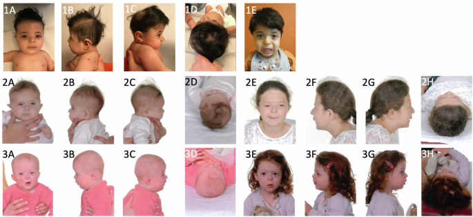 Fig. 2: Facial phenotype of Patients 2, 3 and 4.