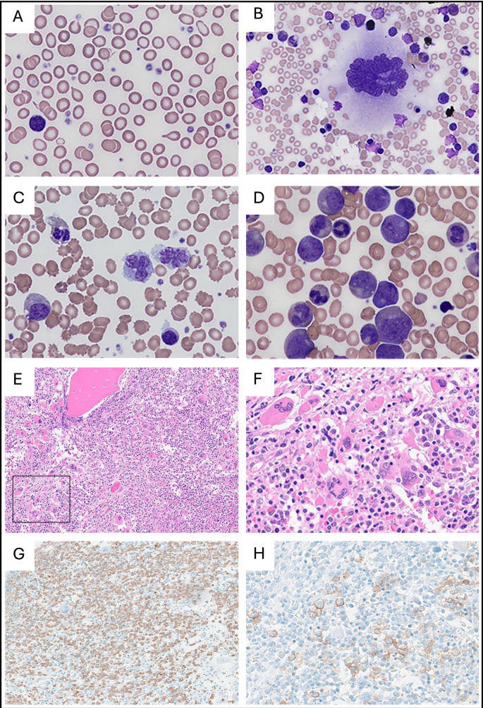 Fig. 2: Peripheral blood and bone marrow findings in patients with SH2B3 germline variants.