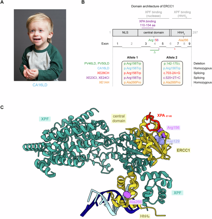 Fig. 1: A small cohort of patients with ERCC1-hepatorenal syndrome.