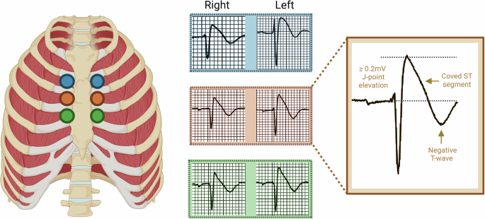 Fig. 1: Demonstration of the recording of a high lead ECG with the precordial leads V1 and V2 placed in the second (blue), third (orange), and fourth (green) intercostal spaces.