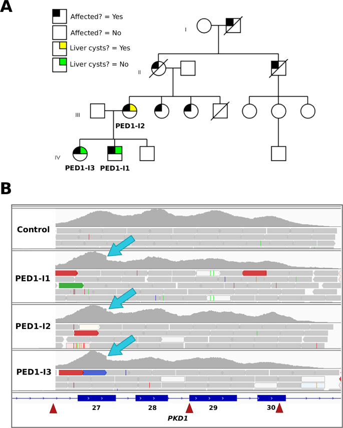 Fig. 1: Family PED1 with a heterozygous deletion in PKD1 causing ADPKD.