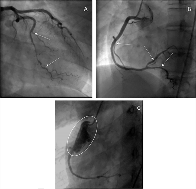 Fig. 1: Angiographic findings.