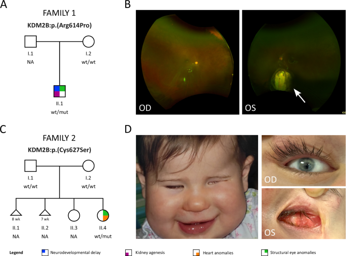 Fig. 1: Novel families with pathogenic KDM2B variants and structural eye anomalies.