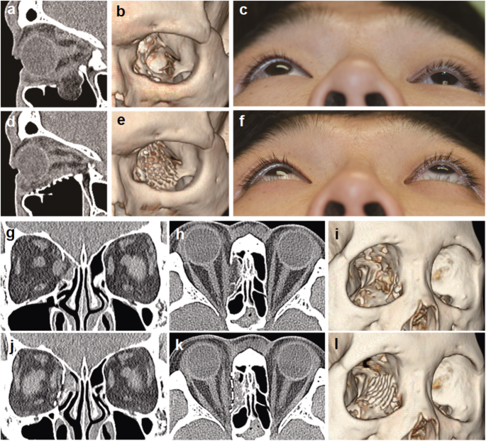 Generation Of Customized Orbital Implant Templates Using 3