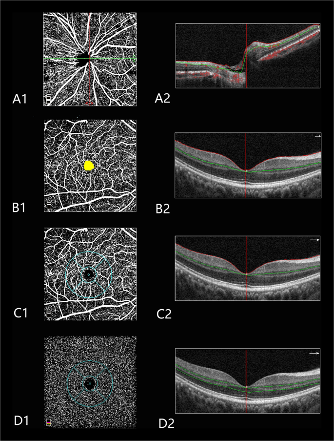 viziune anizotropică viziunea 7 cu operație de astigmatism