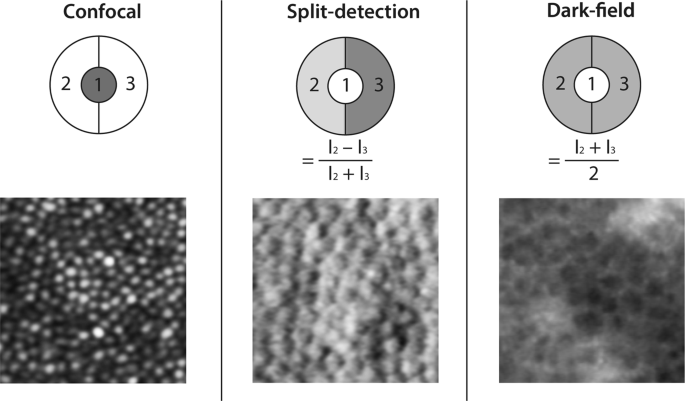 Cellular imaging of inherited retinal diseases using adaptive optics | Eye