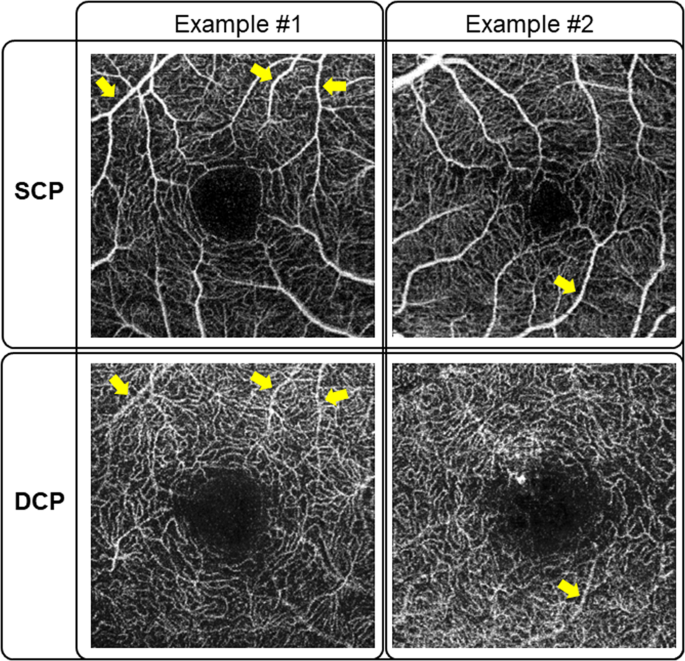 Optical Coherence Tomography Angiography In Diabetic Retinopathy An Updated Review Eye