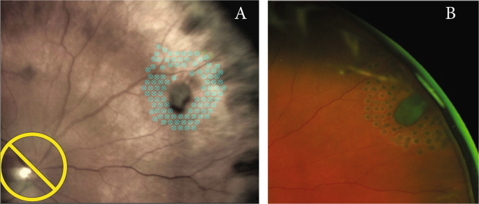 Safety and efficacy of the use of navigated retinal laser as a method of  laser retinopexy in the treatment of symptomatic retinal tears | Eye