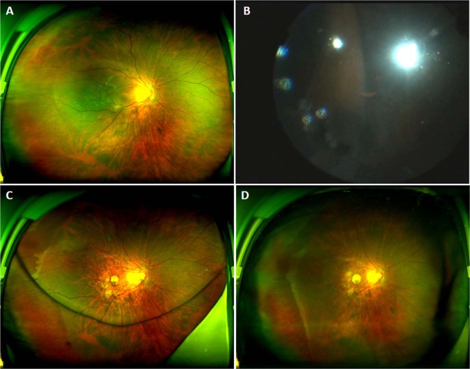 Fig. 1: Ultra-widefield images of the left eye of patient 3.
