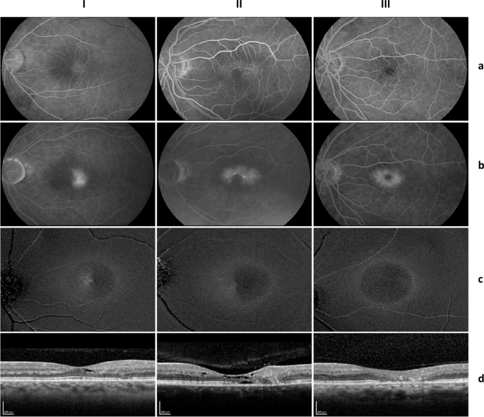 Imaging endpoints for clinical trials in MacTel type 2 | Eye