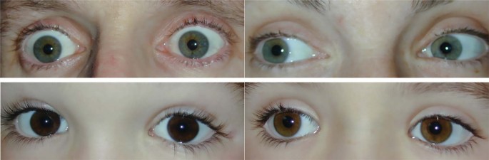 What colour are your eyes? Teaching the genetics of eye colour & colour  vision. Edridge Green Lecture RCOphth Annual Congress Glasgow May 2019 | Eye