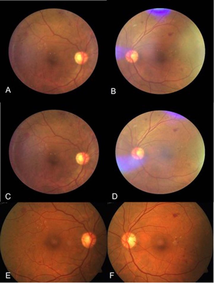 Selfie fundus imaging for diabetic retinopathy screening | Eye