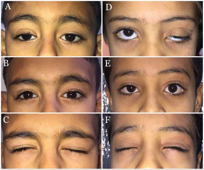 Reconstruction of eye-closure and blinking reflex