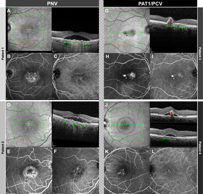 Fig. 1: Comparison of two cases PNV and two cases of PAT1/PCV.
