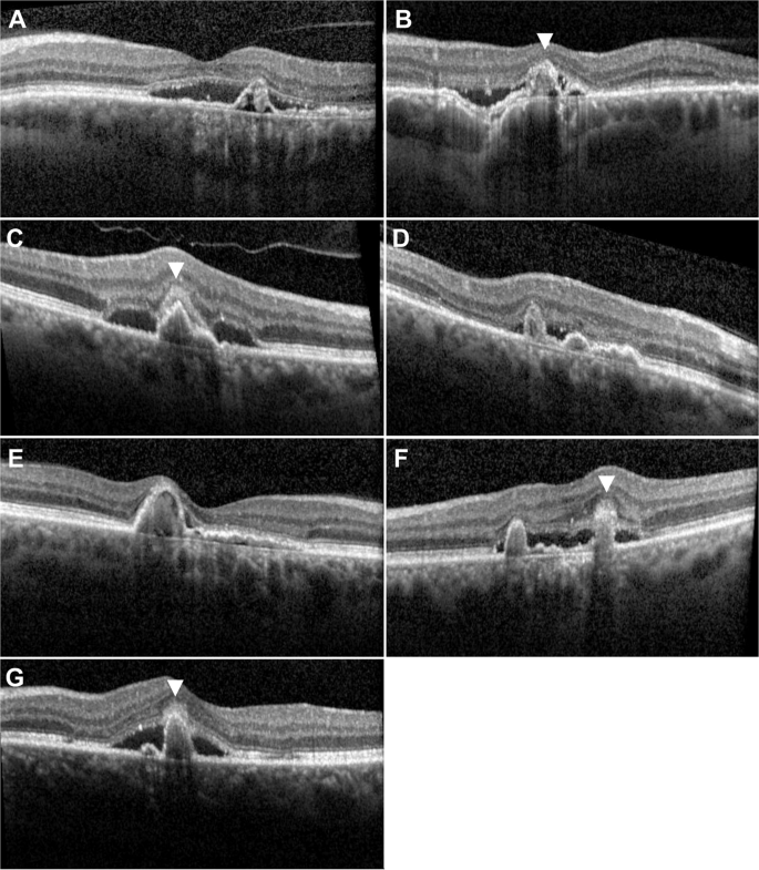 Fig. 2: OCT scans of all seven cases of PAT1/PCV primarily misdiagnosed as PNV.