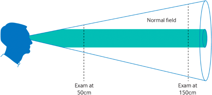 Fig. 2: In functional visual loss a tubular visual field arises primarily because of a strong “prediction” of tunnel vision in keeping with an / predictive processing model of how the brain works.