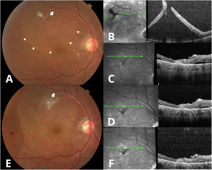 Fig. 1: Clinical and SD-OCT evaluation of combined retinal detachment treated with LAM and SF6 tamponade.