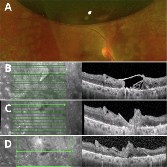 Fig. 2: Clinical and SD-OCT evaluation of a retinal break treated with LAM and air room tamponade.
