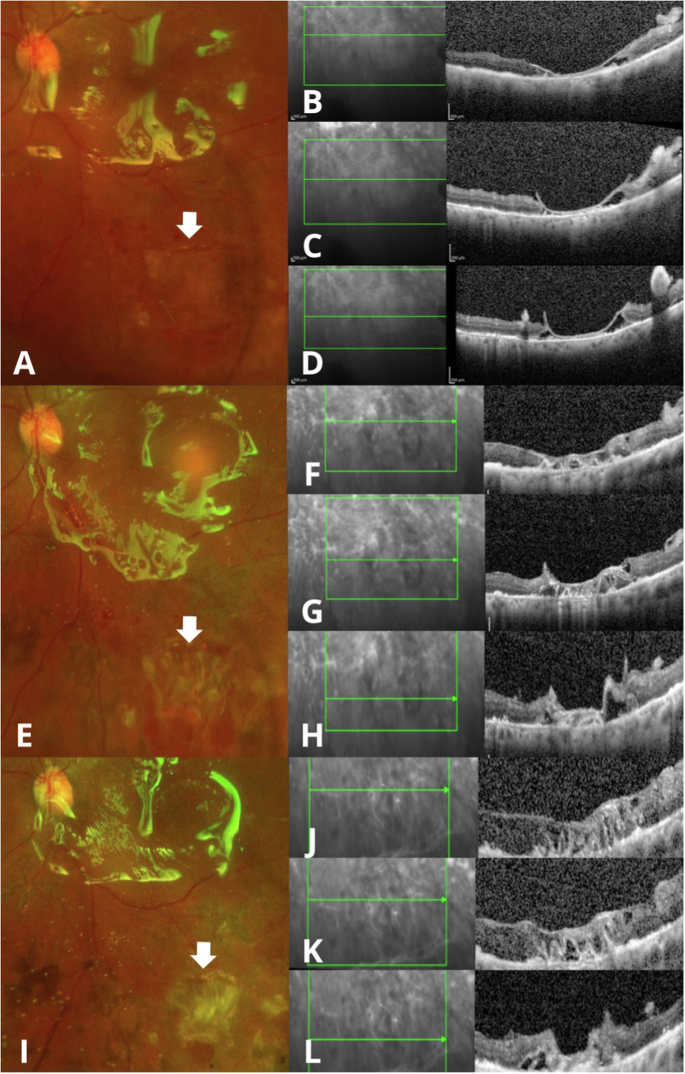 Fig. 3: Clinical and SD-OCT evaluation of combined retinal detachment treated with LAM and silicone oil tamponade.