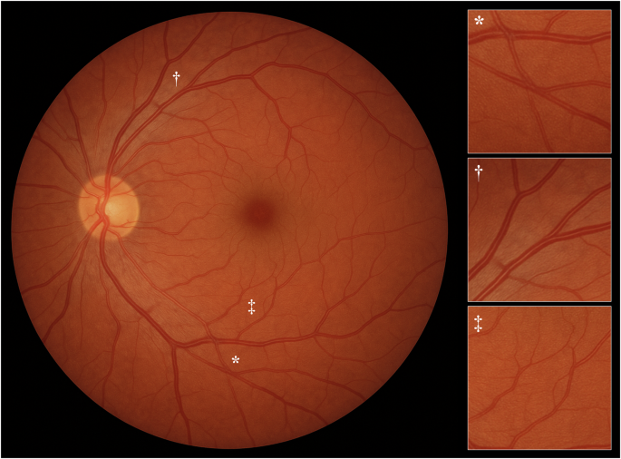 A fundus photograph generated by GPT-4o from a text prompt, with magnified views showing fabrication artifacts.