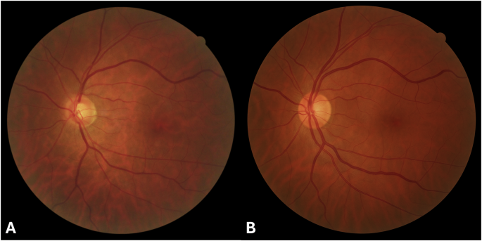 A comparison between a real fundus photograph and a more realistic synthetic version generated by GPT-4o using the real image as a reference.