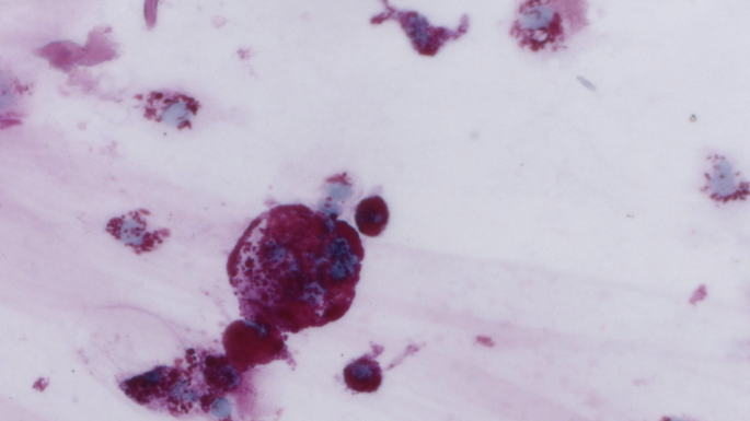 Fig. 3: PAS positive macrophages in vitreous fluid.