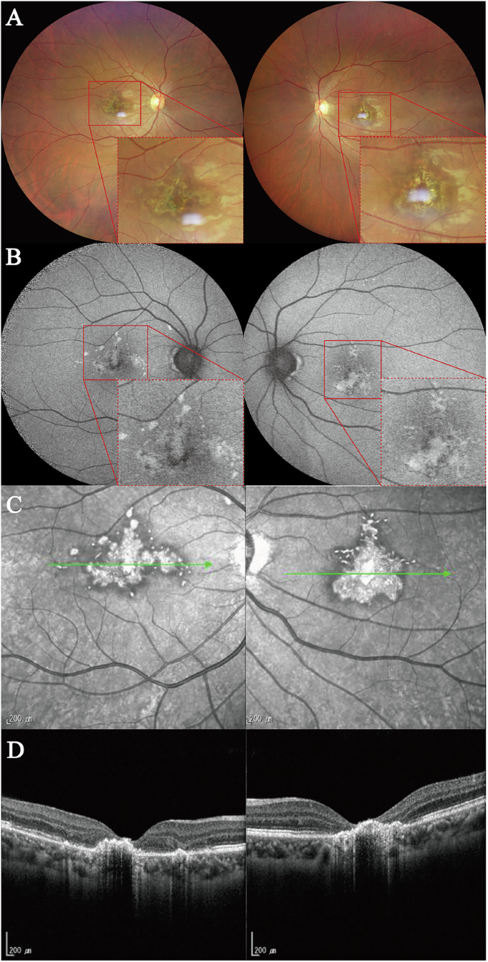 The unseen danger: cumulative laser-induced maculopathy from indirect ...