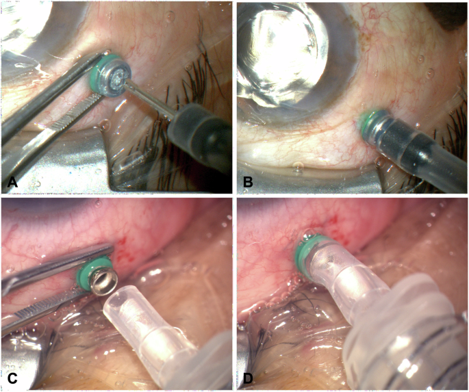 Fig. 1: Application of the standard infusion tube and the 23G trocar sleeve adapter for silicone oil injection.