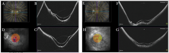 Fig. 2: Anatomical and functional success of MB in a MS-MD case.