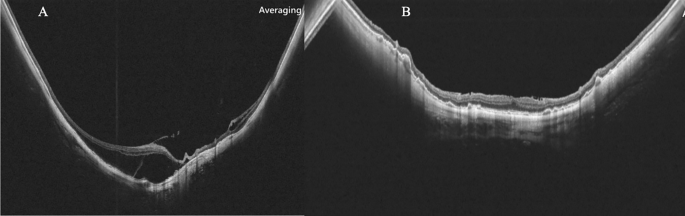 Fig. 3: Successful case of PPV+ILM peeling+ MB.