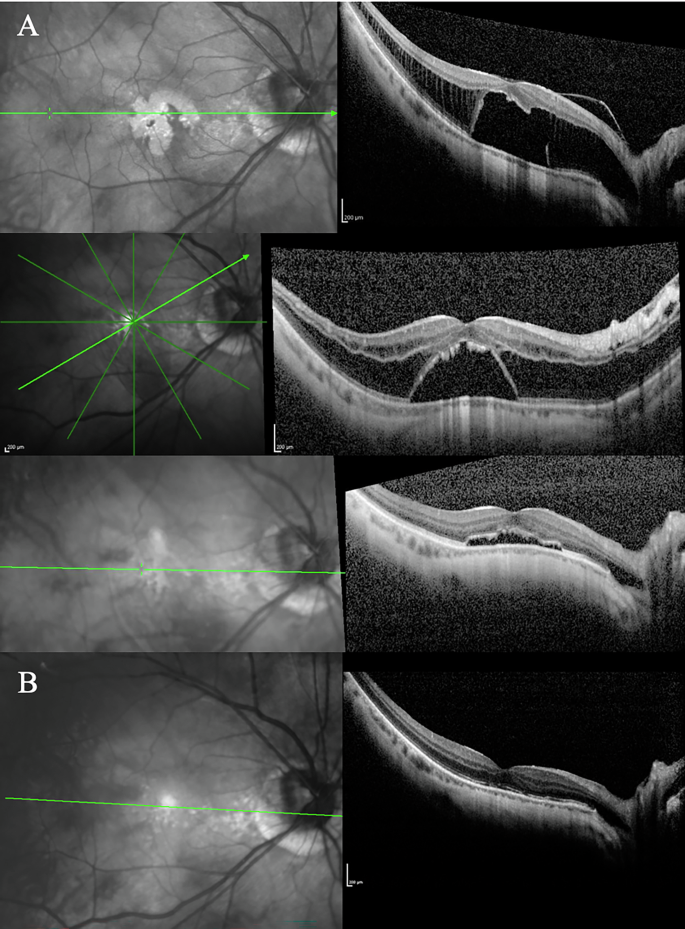 Fig. 4: Outer lamellar macular hole case.