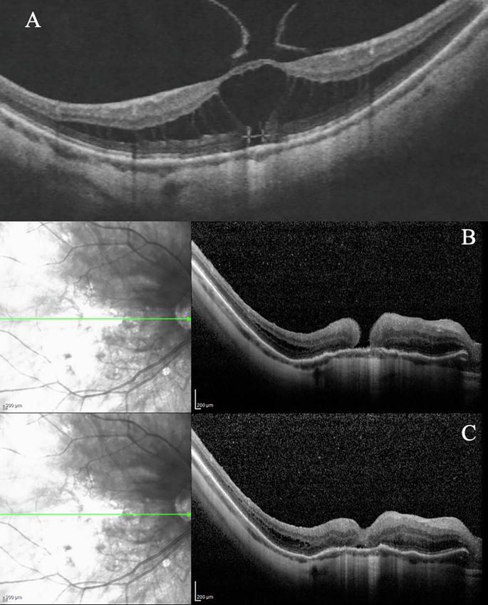 Fig. 5: Development of a full thickness macular hole after PPV+ILM peeling.