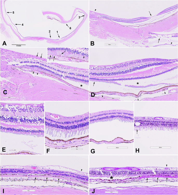 Fig. 1: Case 2, histopathologic findings of the left retina, RPE, and choroid outside of pseudo-retinitis pigmentosa changes reported previously [18].