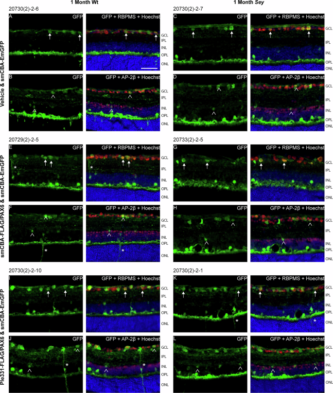 Fig. 3: Histological imaging of GFP expression at 1 month revealed viral transduction of multiple retinal cell types, including ganglion cells, amacrine cells, horizontal cells, and Müller glia.