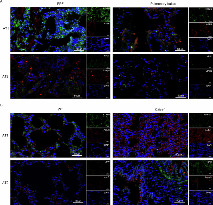 Fig. 1: Immunofluorescence detection of alveolar epithelial cell subtypes in patients and rats.