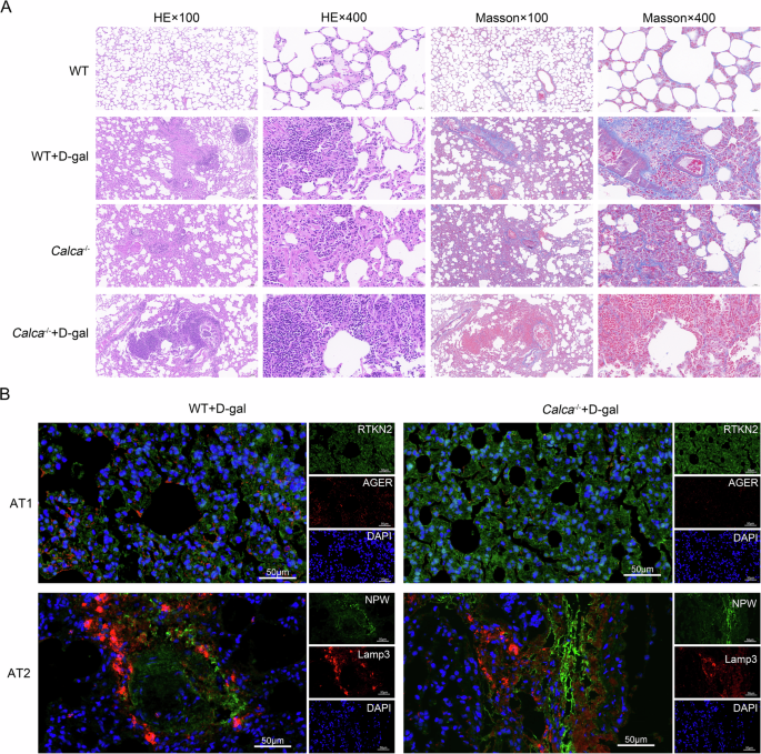 Fig. 5: Alveolitis and fibrosis in D-gal and Calca-/- groups.