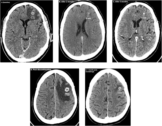 Fig. 1: Evolution of a brain metastasis on cabozantinib in patient 15.