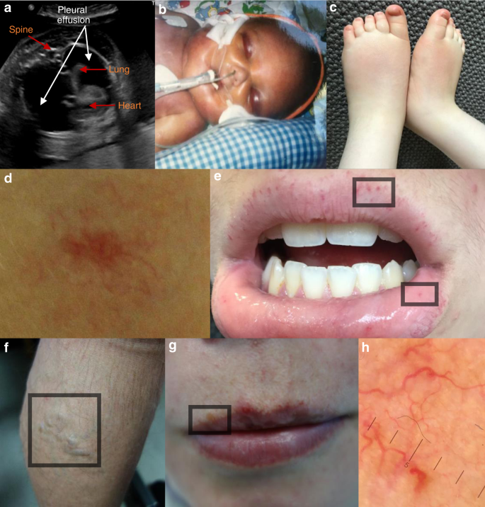 Fig. 1: Clinical findings in individuals with EPHB4 variants.