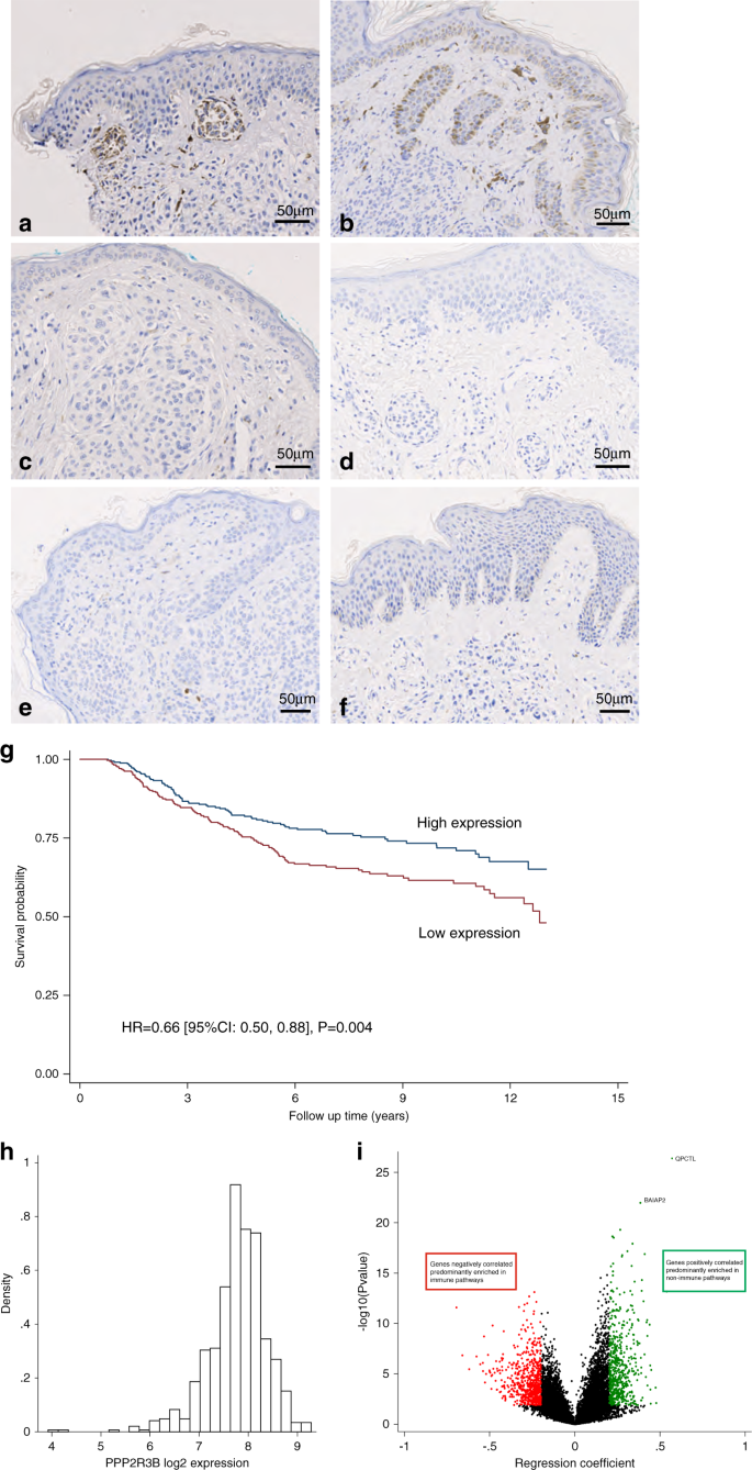 Fig. 2: Germline duplications of PPP2R3B lead to increased expression of protein product PR70 in congenital melanocytic nevi (CMN) tissue, compared to that of normal copy-number controls.
