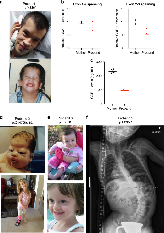 Fig. 1: Overview of patients with GDF11 variants.
