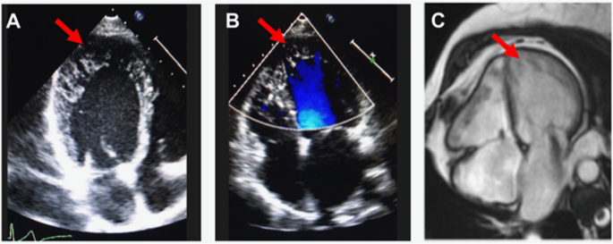 Fig. 1: Echocardiogram and cardiac magnetic resonance imaging in LVNC.