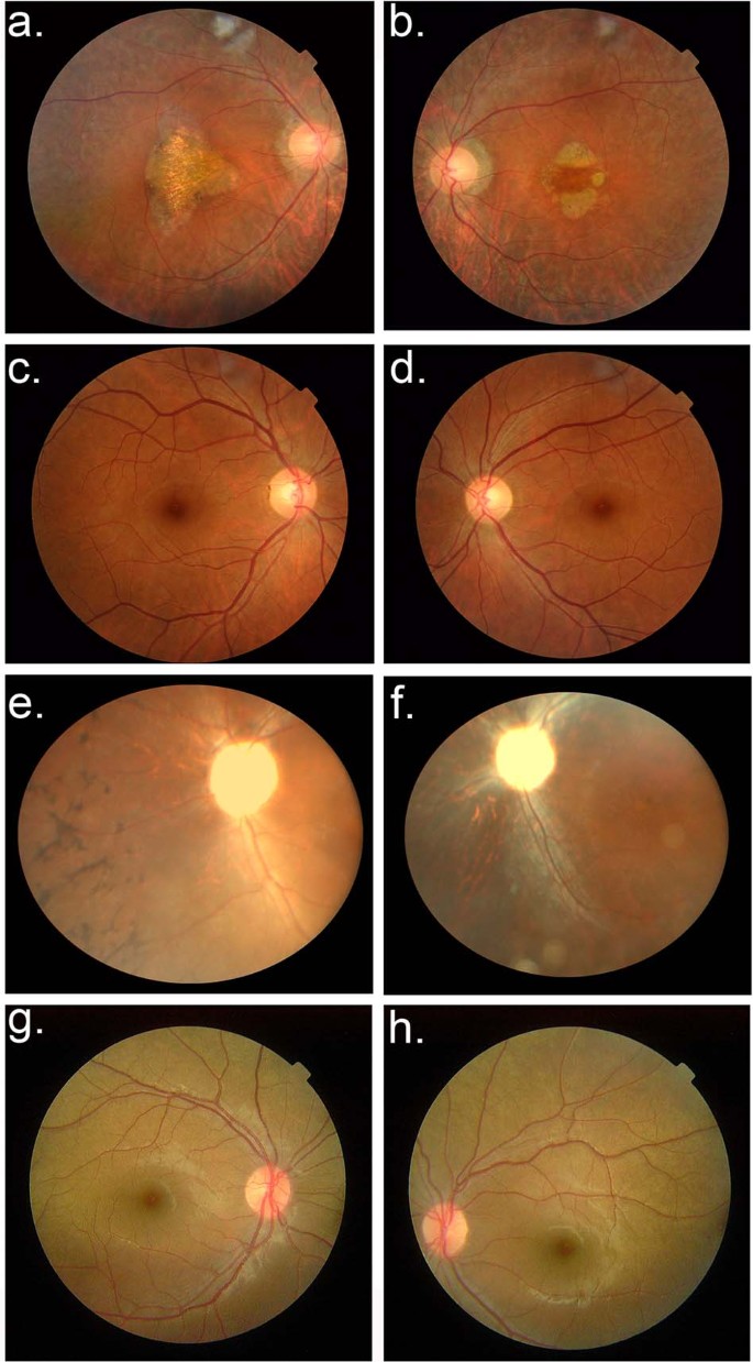 Fig. 1: Fundus photographs of individuals examined for retinitis pigmentosa.