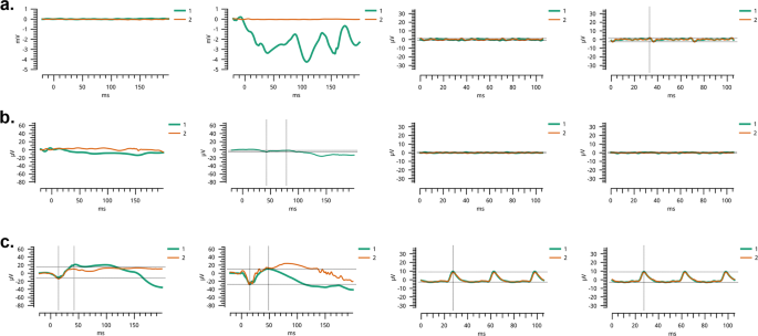 Fig. 2: Electroretinography recordings of individuals examined for retinitis pigmentosa.