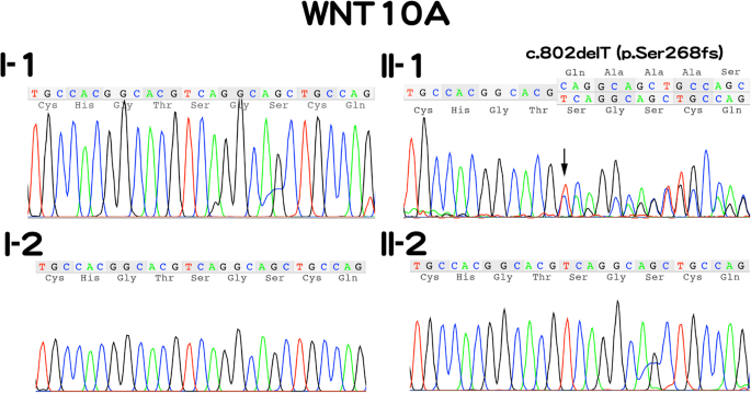 Fig. 2: Electropherograms of Sanger sequencing of the WNT10A gene of all members of the family.