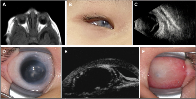 Fig. 1: Ocular imaging findings of the two cases.